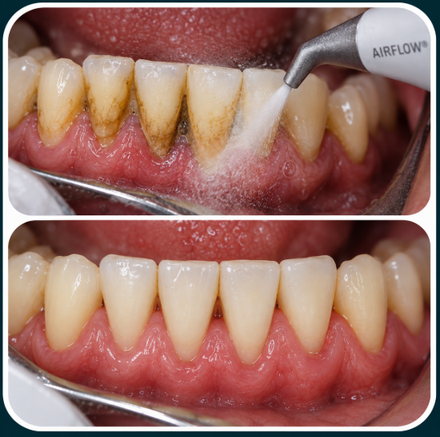 Destartarização e jato de bicarbonato, antes e depois
