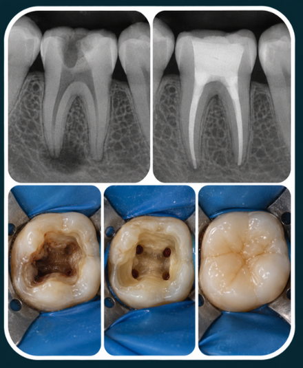 Radiografias e dentes tratados endodonticamente