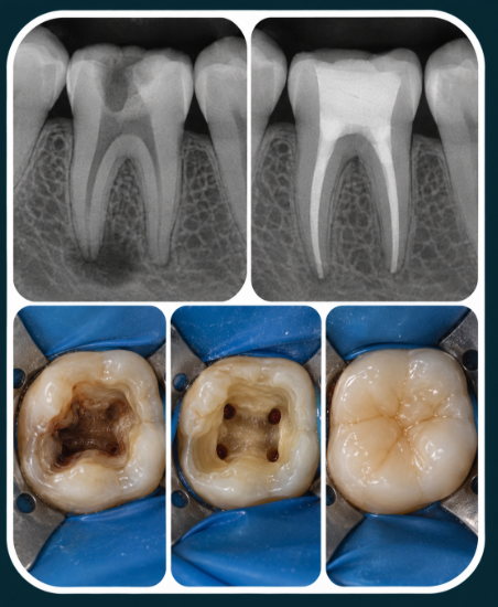 Radiografias e dentes tratados endodonticamente