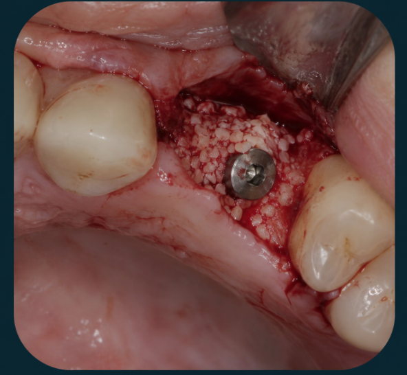 Colocação de implante dentário