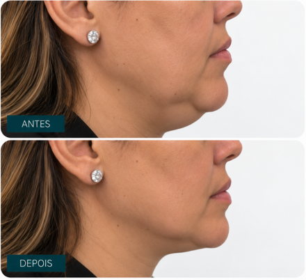 Caso clínico — contorno mandibular, antes e depois