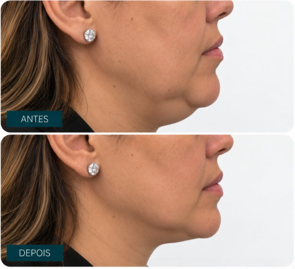 Caso clínico — contorno mandibular, antes e depois